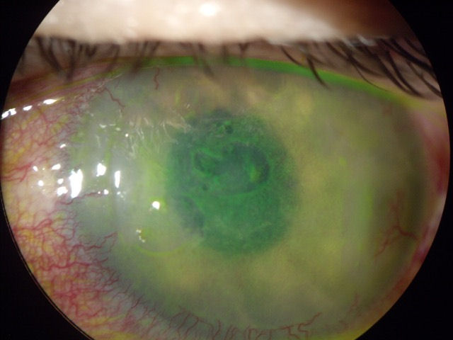 negativne-posledice-lasik-operacije.jpg